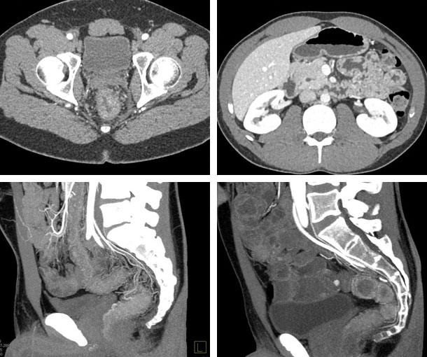 Proctitis CT Findings