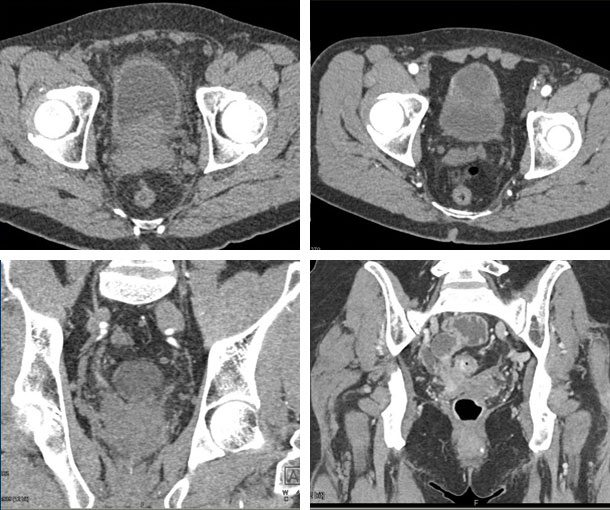 Prostate Adenocarcinoma CT Findings