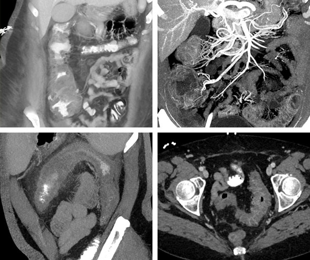 Pseudomembranous Colitis