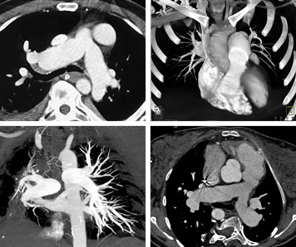 Pulmonary Artery Hypertension (PAH) CT Findings