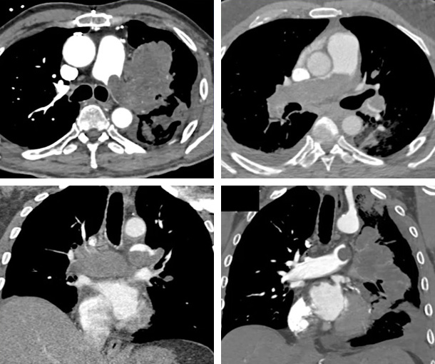 Pulmonary Artery Sarcoma