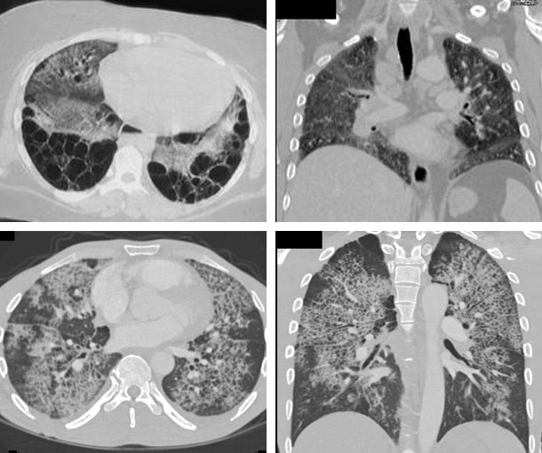 Pulmonary Edema CT Findings
