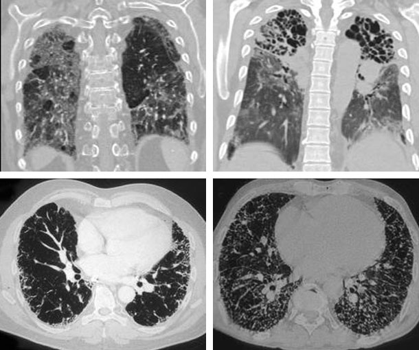 Pulmonary Fibrosis CT Findings