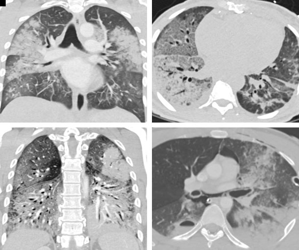 Pulmonary Hemorrhage