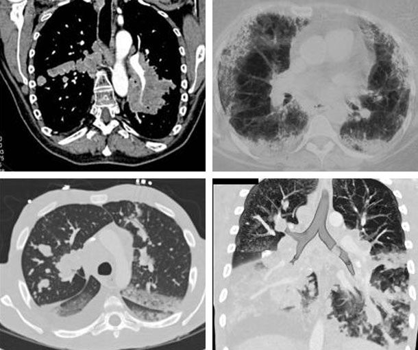 Pulmonary Lymphoma CT Findings