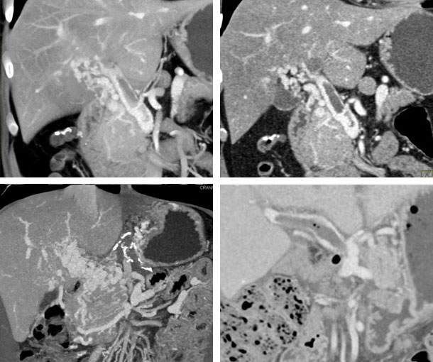 PVT CT Findings