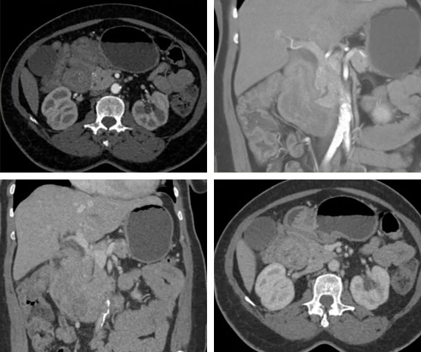 Gastric Pyogenic Granuloma CT Findings