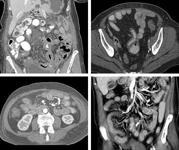 Radiation Enteritis CT Findings
