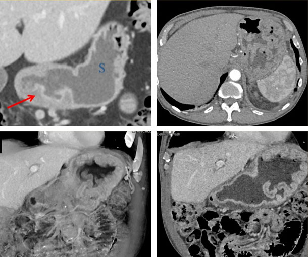 Reactive Gastropathy CT Findings