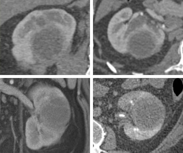 Renal Abscess CT Findings