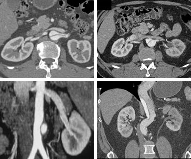 Renal Artery Dissection CT Appearance