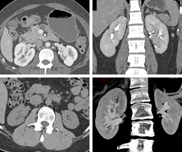 Renal AVM CT Findings