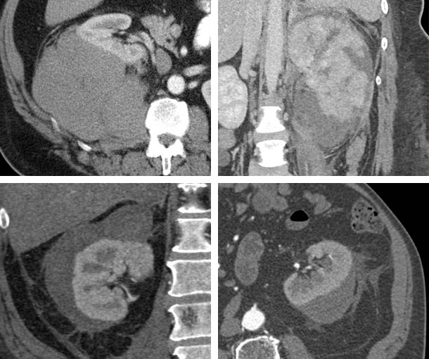 Renal Hematoma CT Findings