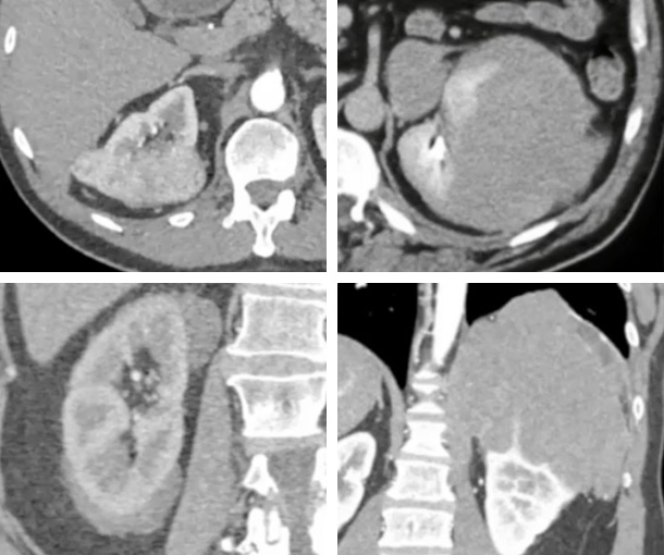 Renal Lymphoma CT Findings