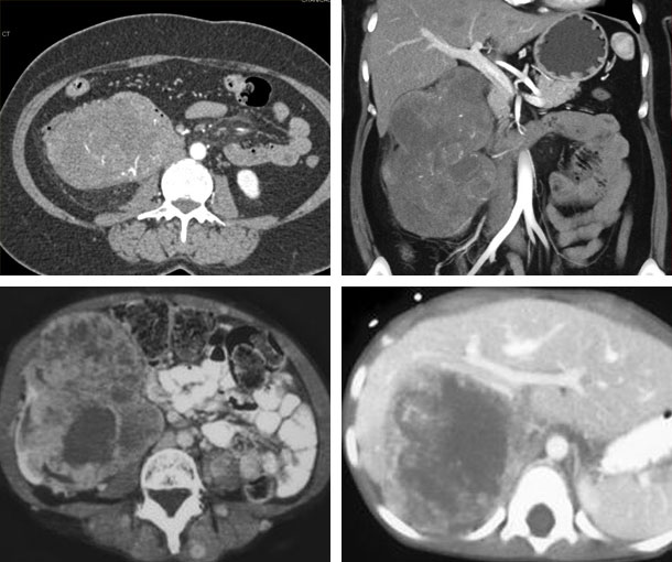Renal Sarcoma CT Appearance