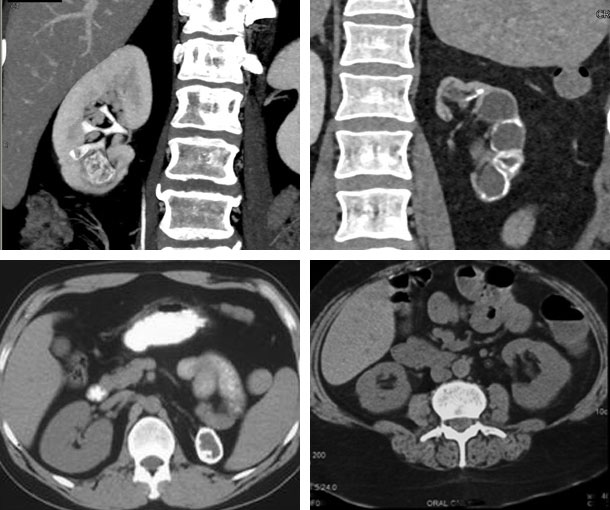 Renal Tuberculosis CT Appearance