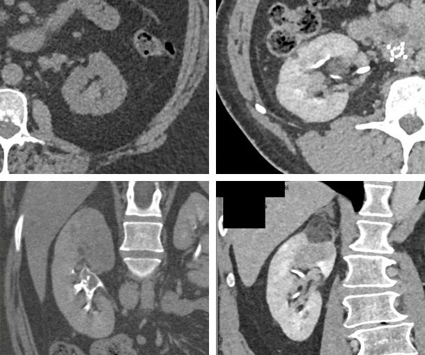 Renal TCC CT Findings