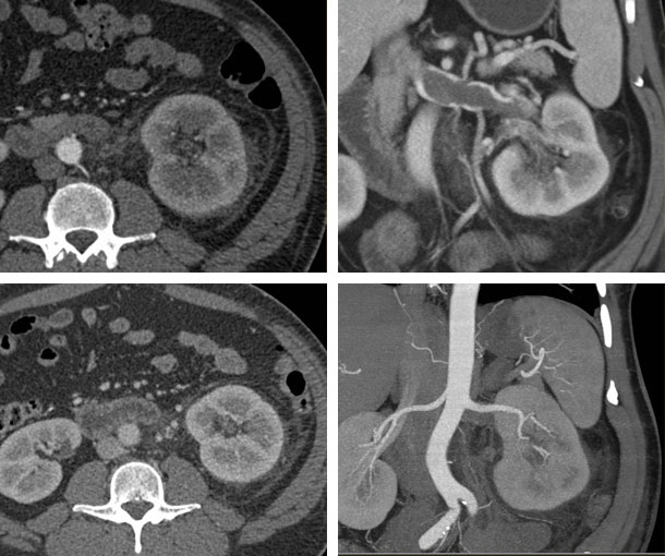 Renal Vein Thrombosis CT Findings