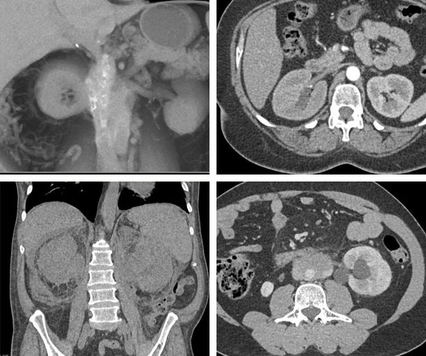 Retroperitoneal Fibrosis CT Findings