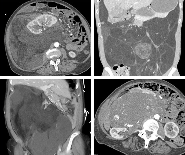 Retroperitoneal Liposarcoma