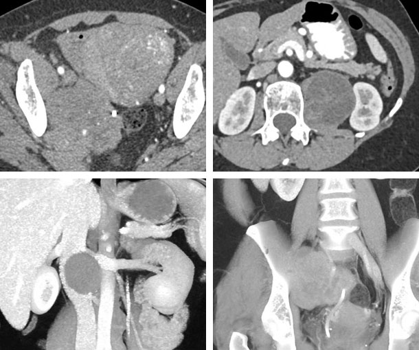 Schwannoma