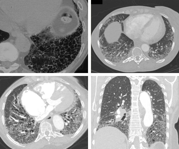 Scleroderma CT Findings