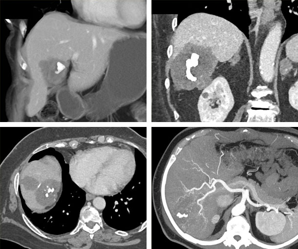 Sclerosed Hemangioma CT Findings