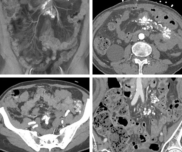 Sclerosing Mesenteritis CT Findings