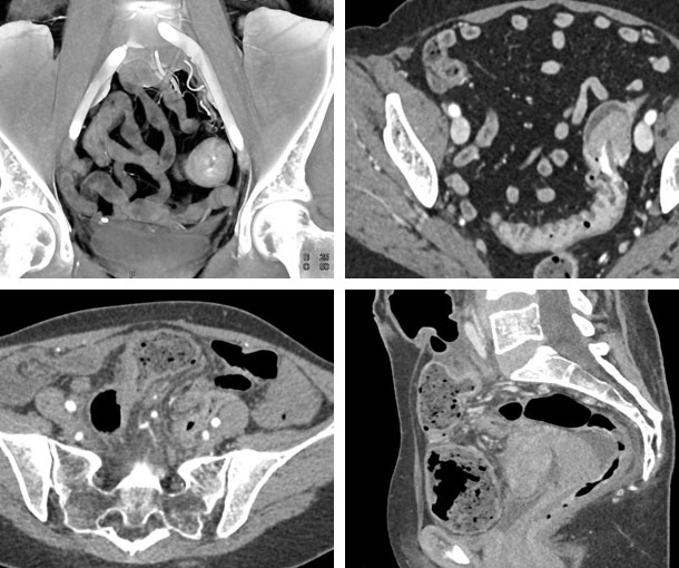 Sigmoid Colon Cancer