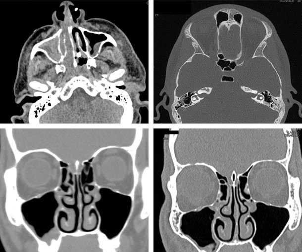 Sinusitis CT Findings
