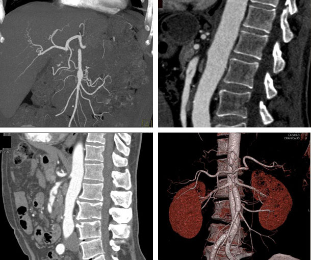 SMA Dissection CT Findings