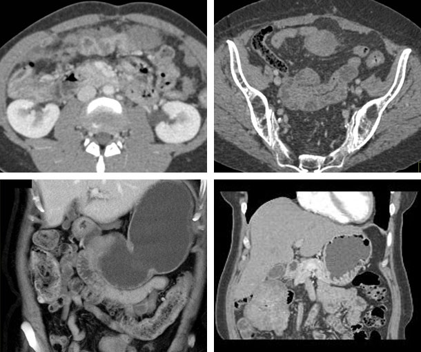 Small Bowel Desmoid Tumor CT Findings