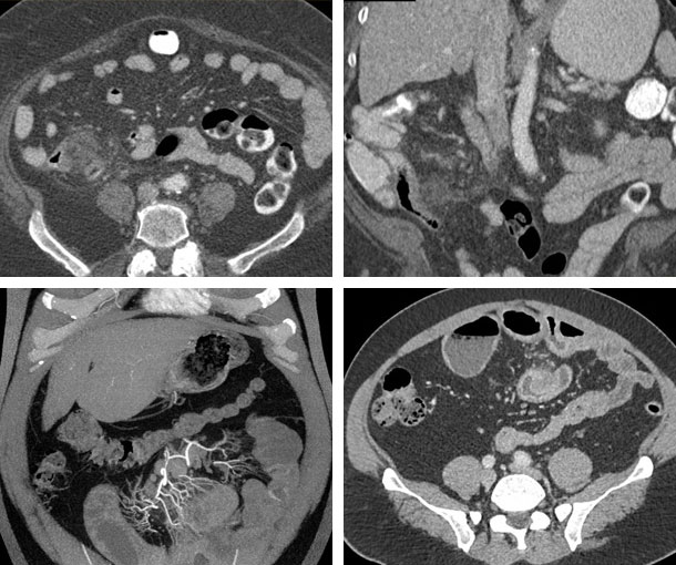 Small Bowel Diverticulitis CT Findings