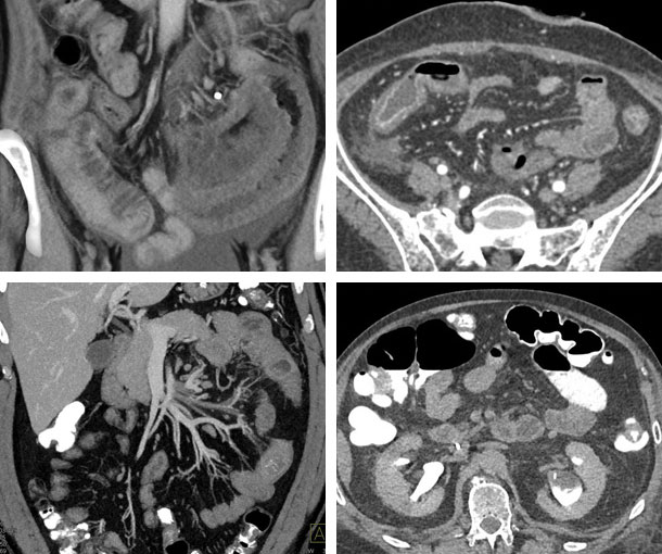 Small Bowel Enteritis CT Findings