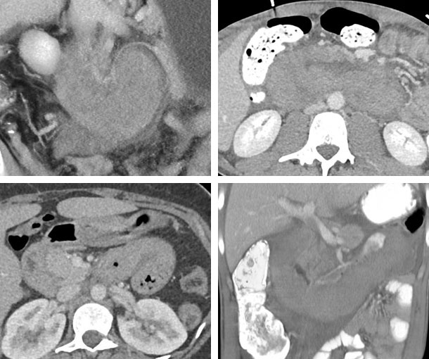 Small Bowel Hematoma CT Findings