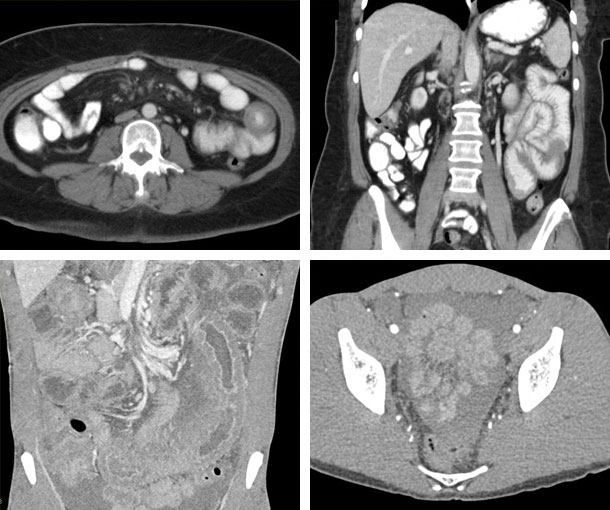 Small Bowel Hemorrhage CT Findings