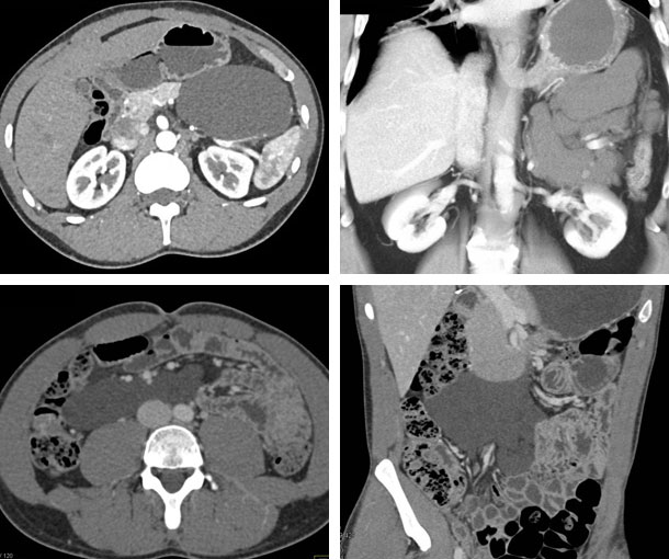 Small Bowel Lymphangioma CT Findings