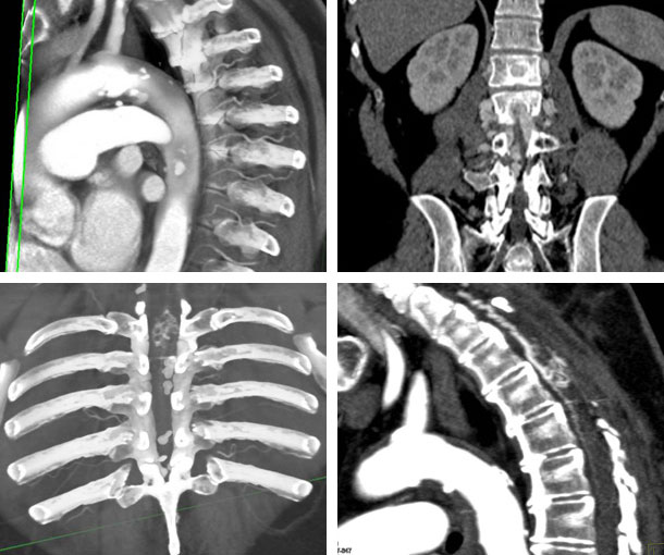 HSpinal Arteriovenous Malformation (AVM) CT Findings