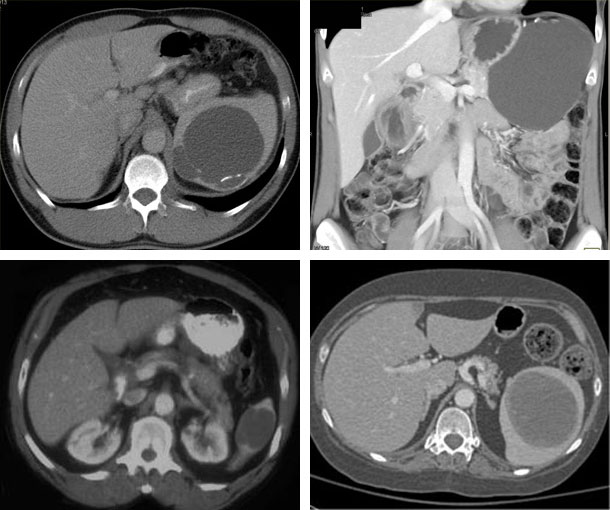 Splenic Epidermoid Cyst CT Findings