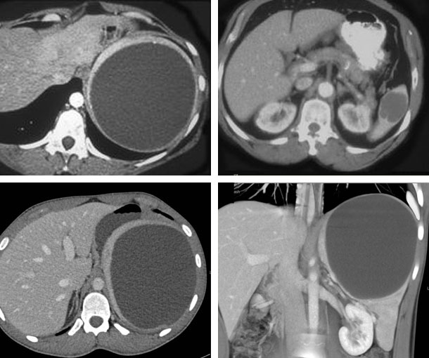 Splenic Epithelial Cyst CT Appearance