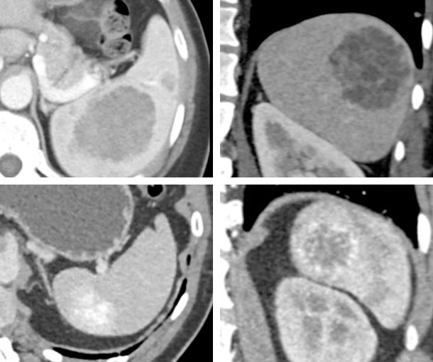 Splenic Hemangioma CT Findings