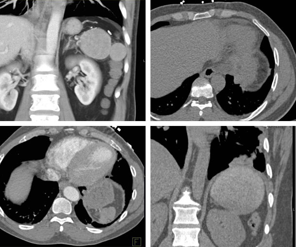Splenosis CT Appearance