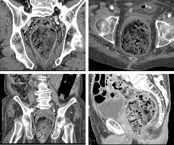 Stercoral Colitis CT Findings