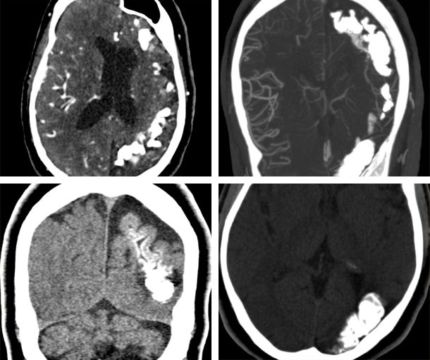 Sturge-Weber Syndrome CT Findings