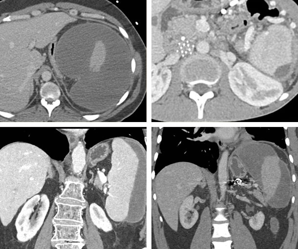 Subcapsular Splenic Hematoma CT Findings