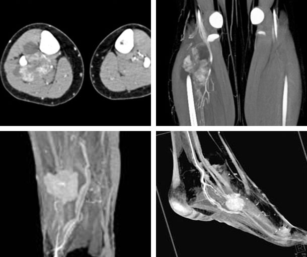 Synovial Sarcoma CT Findings