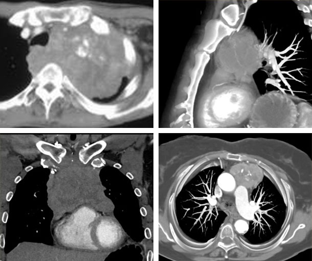 Thymic Carcinoma CT Findings