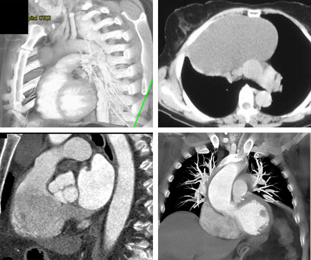 Thymic Cyst CT Findings