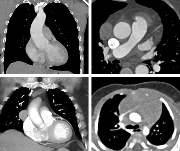 Thymoma