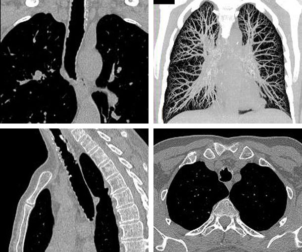 Tracheobronchopathia Osteochondroplastica CT Findings